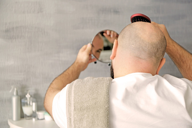 Przyczyną łysienia androgenowego jest nadwrażliwość meszków włosowych na DHT /123RF/PICSEL