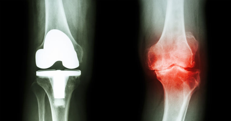 Przyczyny osteoartrozy /&copy;123RF/PICSEL