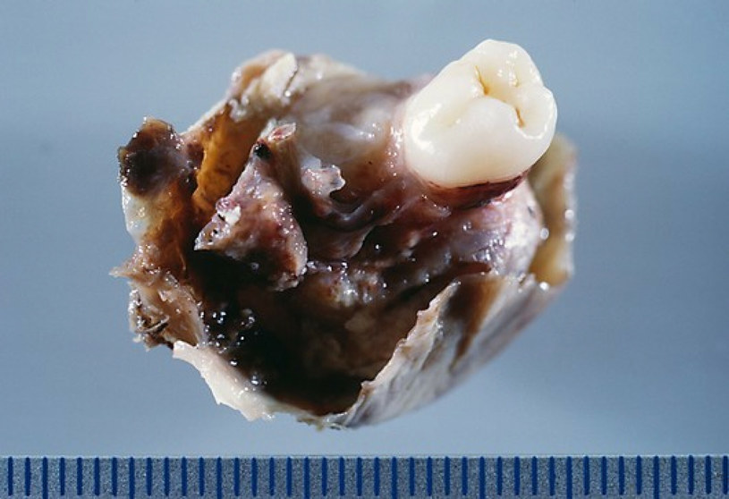 Przykład potworniaka, w którym doszło do rozwoju tkanki kostnej, dokładnie zęba /Science Photo Library/EAST NEWS /East News