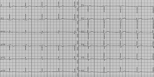 Przykładowe EKG /