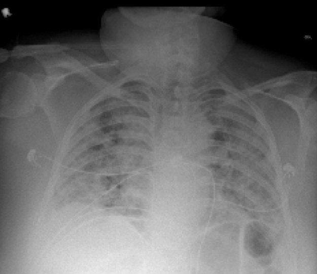 Przykładowe zdjęcie klatki piersiowej pacjenta hospitalizowanego z Covid-19 /Nature Publishing / npj Digital Medicine /Materiały prasowe