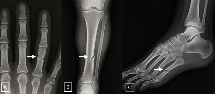 Przykłady radiogramów złamań wygenerowanych przez GPT-4o. Obrazy pokazują linie złamań, które są gładkie, czyste i jednolite. /Radiological Society of North America (RSNA) /Materiały prasowe