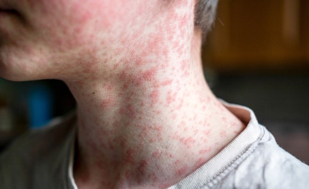 Przypadki odry na Podkarpaciu. Tak wyglądają pierwsze objawy