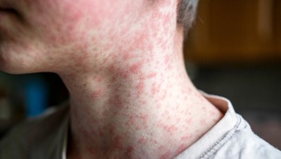 Przypadki odry na Podkarpaciu. Tak wyglądają pierwsze objawy