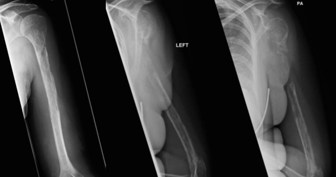 Radiograf 44-letniej pacjentki pokazuje relokacje niszczonej kości ramiennej, która nastąpiła w ciągu 18 miesięcy /materiały prasowe