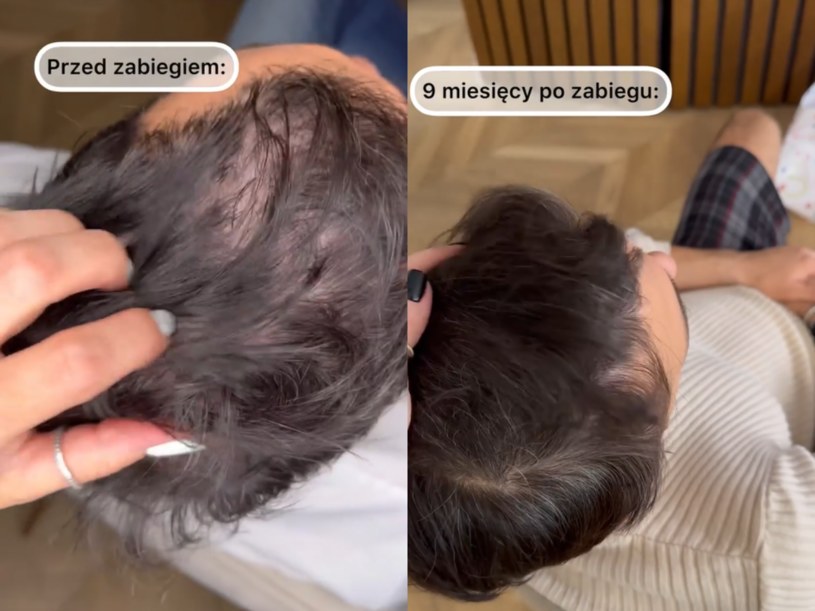 Rafał Maślak przeszczepił sobie włosy. Teraz dumnie prezentuje czuprynę