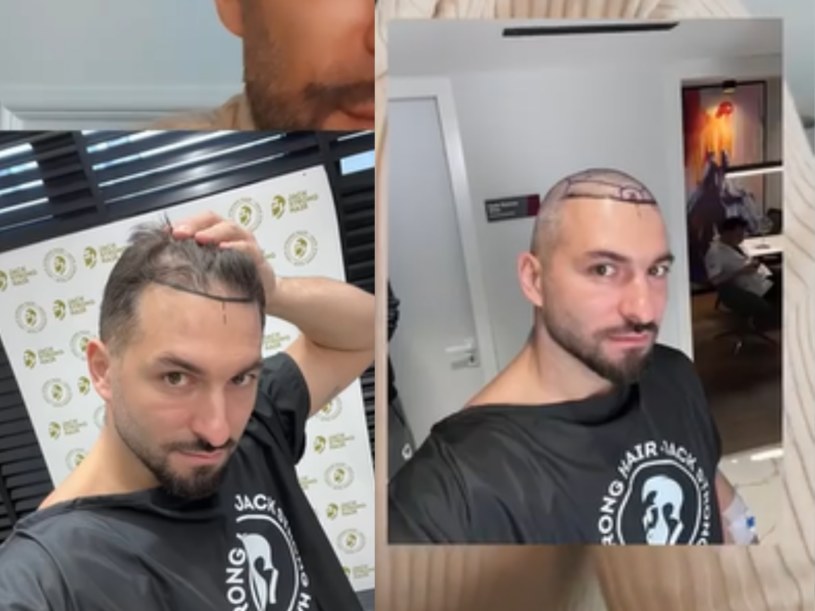 Rafał Maślak przeszczepił sobie włosy. Teraz dumnie prezentuje czuprynę