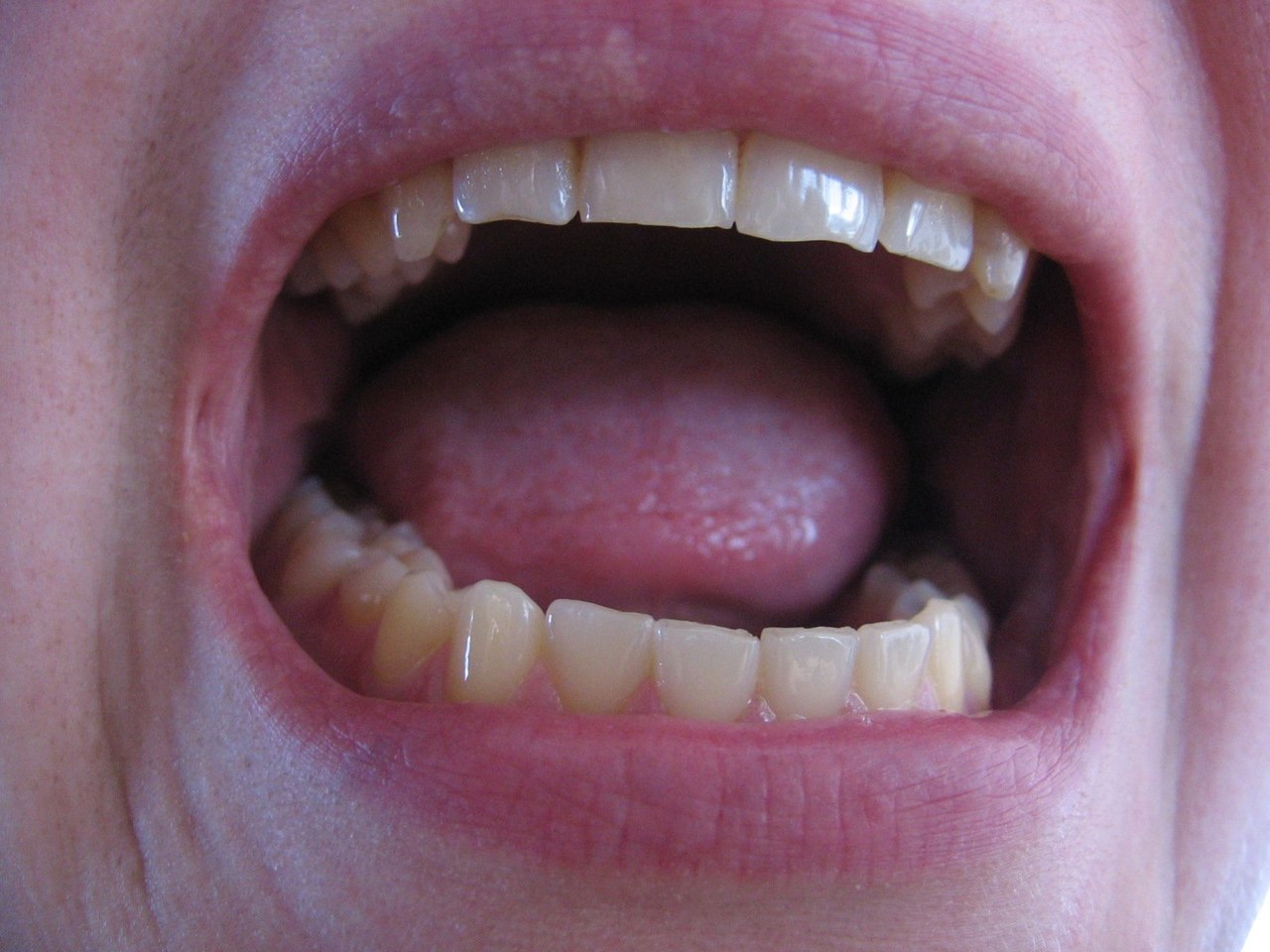 Jakie Sa Objawy Raka Jamy Ustnej Porady W Interia Pl