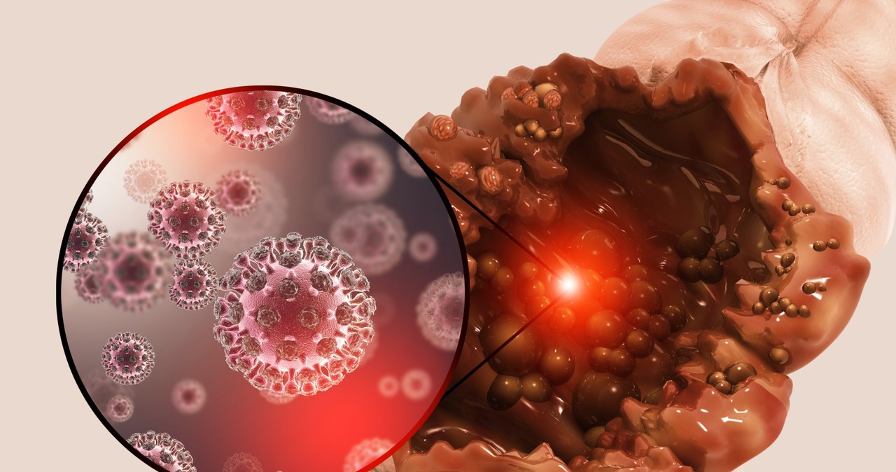 Rak jelita grubego może występować rodzinnie. Wyjaśniamy, jakie badania wykonać, kiedy u członka rodziny wykryto tę chorobę /123RF/PICSEL