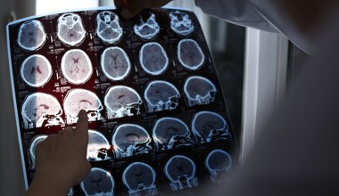 Rak może emitować sygnały chroniące mózg przed chorobą Alzheimera