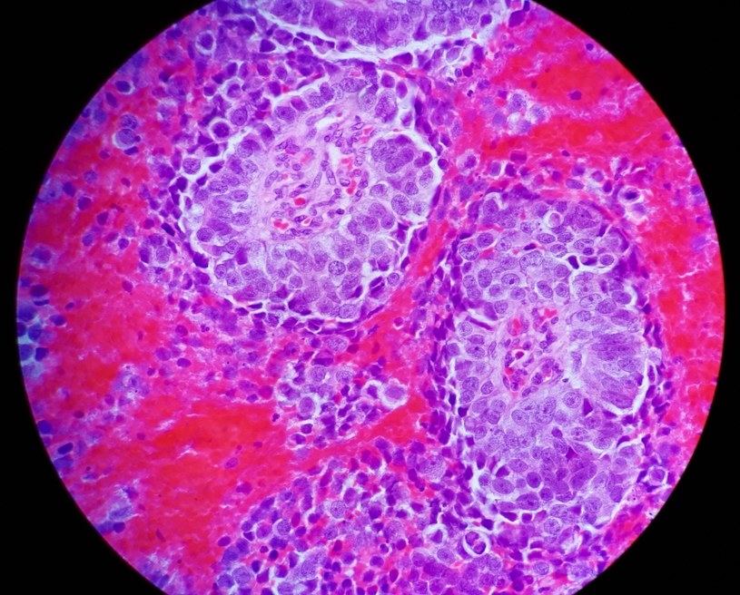 Rak pęcherza moczowego widziany pod mikroskopem /Paulina Łopatniuk /archiwum prywatne
