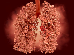 Rak płuca - standardy diagnostyki i leczenia w Polsce