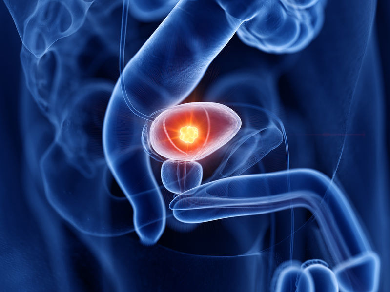 Rak prostaty to jeden z najczęstszych nowotworów atakujących mężczyzn /123RF/PICSEL