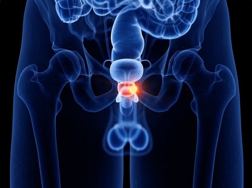 Rak prostaty w większości przypadków, w początkowej fazie, przebiega całkowicie bezobjawowo /123RF/PICSEL