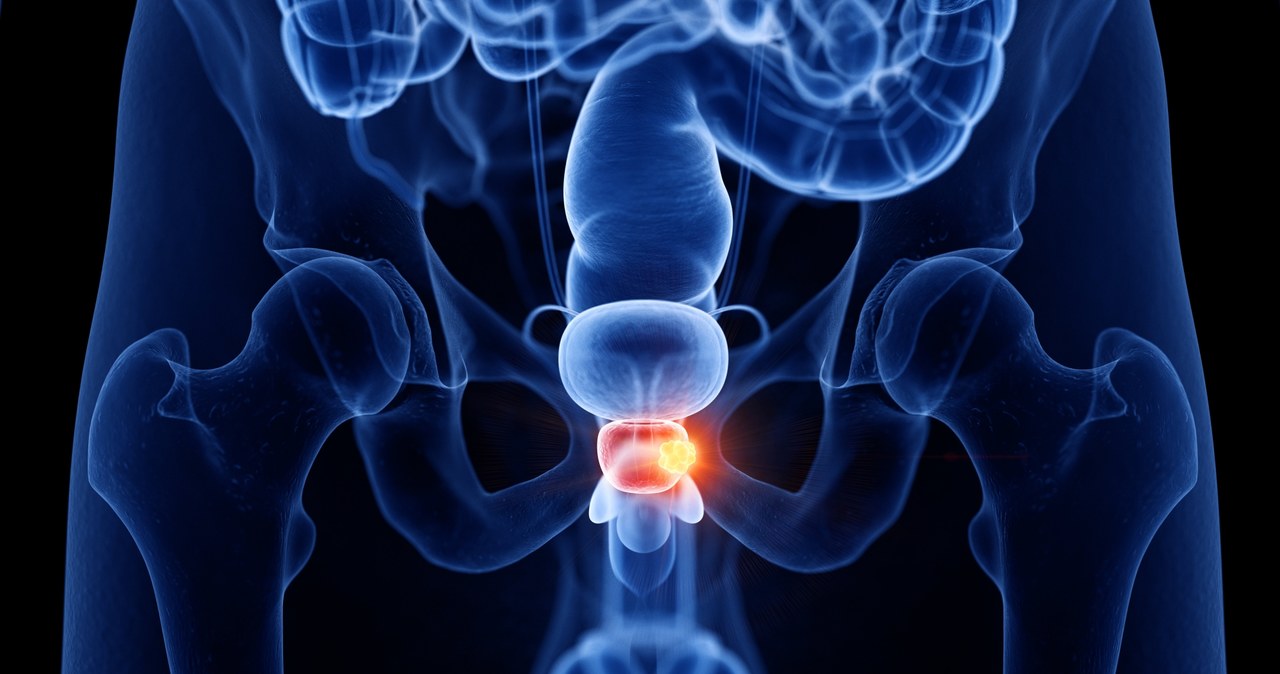 Rak prostaty w większości przypadków, w początkowej fazie, przebiega całkowicie bezobjawowo /123RF/PICSEL