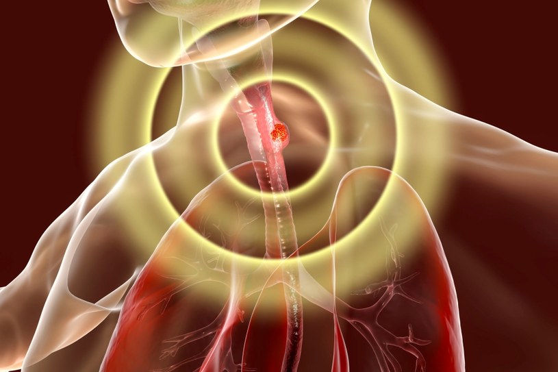 Rak przełyku zabija rocznie 400 tysięcy osób na całym świecie /123RF/PICSEL