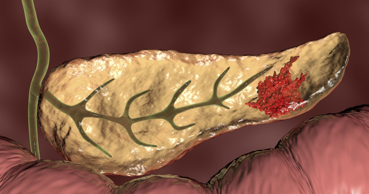 Rak trzustki często bywa wykrywany za późno /123RF/PICSEL