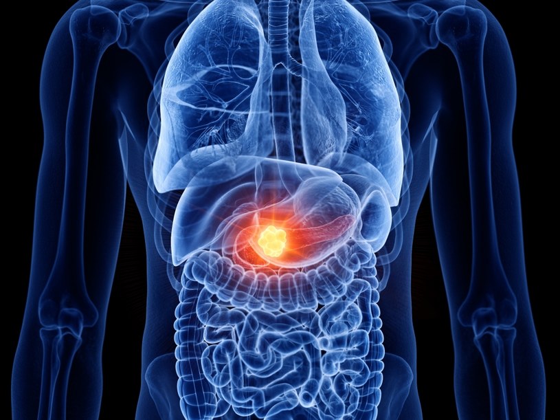 Rak trzustki jest jednym z nowotworów o najgorszym rokowaniu. Od momentu diagnozy pacjenci mają średnio kilka miesięcy życia /123RF/PICSEL