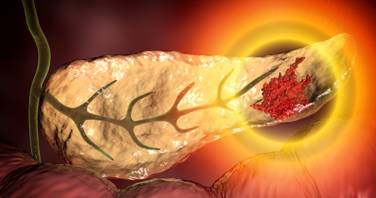 Rak trzustki wykrywany jest zazwyczaj w zaawansowanym stadium /123RF/PICSEL