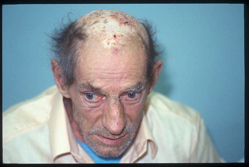 Rany spowodowane przez szkodliwe promieniowanie nie goiły się latami... /Igor Kostin /Getty Images