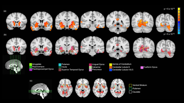 Rejony mózgu 14-latka, w których zauważono zwiększenie objetości materii szarej po jednym lub dwóch przypadkach użycia marihuany /Orr et al., JNeurosci (2019)