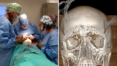 Rekonstrukcja twarzy nastolatka – niezwykły wyczyn chirurgów z Katowic