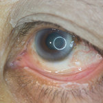Retinopatia cukrzycowa: Przyczyny, objawy i leczenie