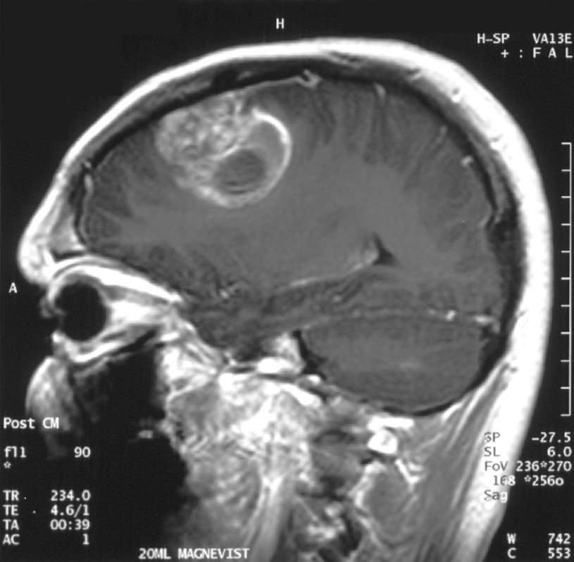 Rezonans na którym widać dużego glejaka w mózgu /Christaras A