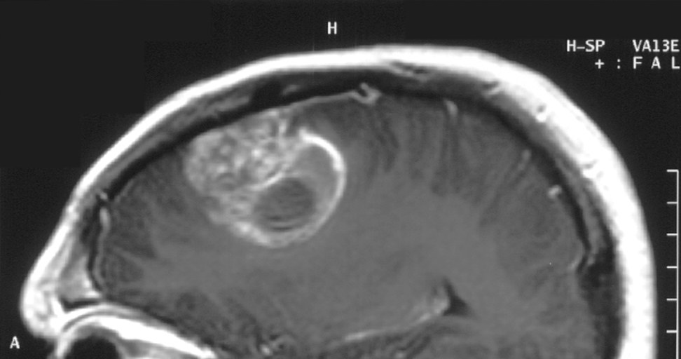 Rezonans na którym widać dużego glejaka w mózgu /Christaras A
