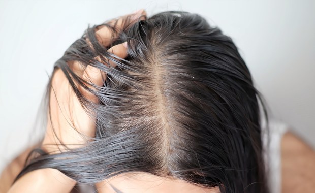 Rodzaj łysienia najtrudniejszy do wyleczenia. Dotyczy głównie kobiet