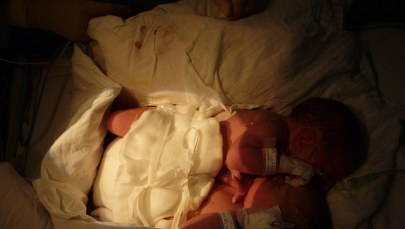 Rozdzielone bliźnięta syjamskie czują się dobrze