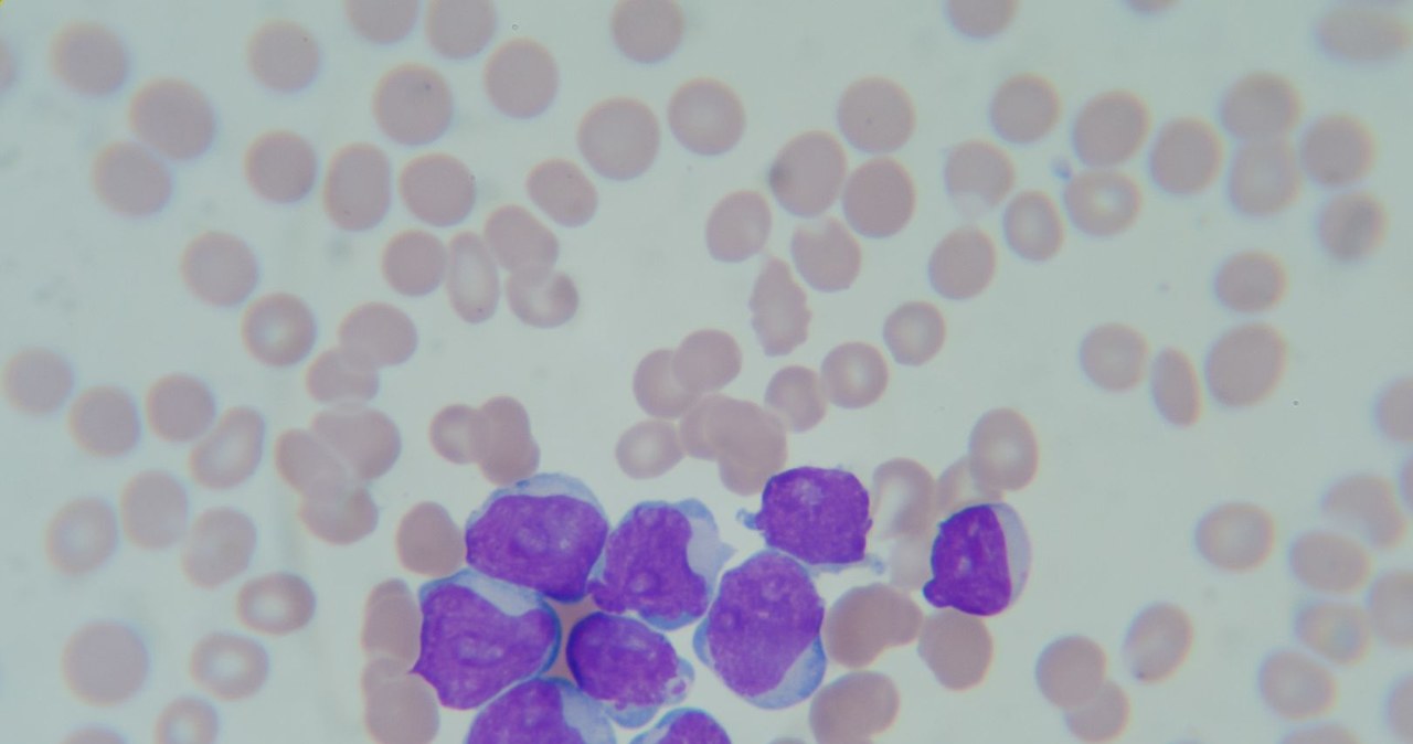 Rozmaz krwi osoby chorej na ostrą białaczkę szpikową /123RF/PICSEL