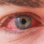 "Różowe oko" - zapalenie spojówek. Występuje u zakażonych Omikronem
