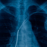 Rozrusznik serca - wskazania do operacji, jej przebieg i życie po zabiegu