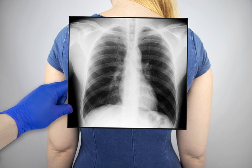 RTG płuc to podstawowe badanie w diagnostyce chorób dolnych dróg oddechowych /123RF/PICSEL