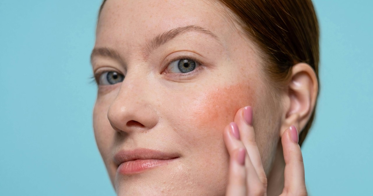 Rumieńce na policzkach od niskiej temperatury /Ron Lach /pexels.com