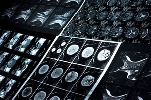 Rzadka dziecięca choroba kluczem do pokonania Alzheimera i Parkinsona