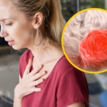 Rzadki nowotwór o złym rokowaniu. Poznaj objawy raka przełyku