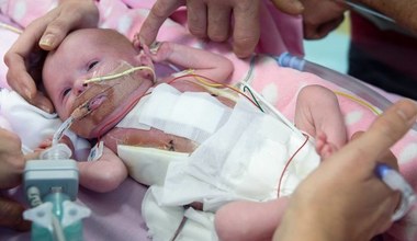 Rzadki przypadek medyczny - dziecko z sercem poza klatką piersiową