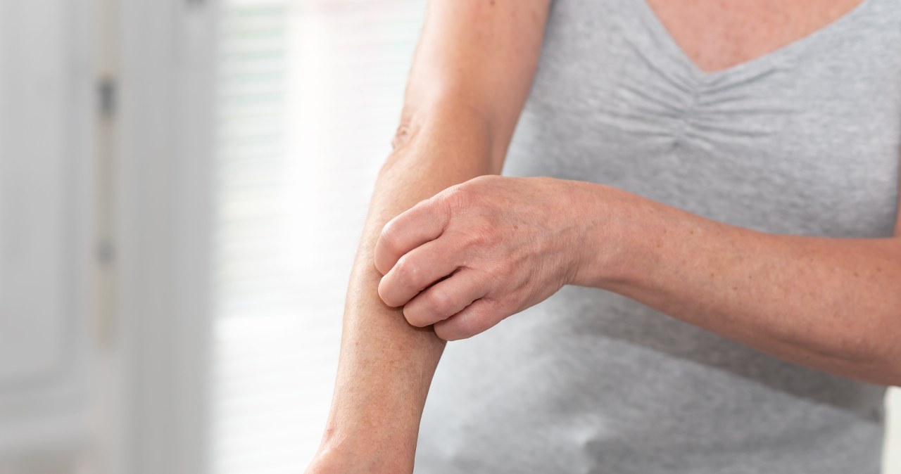 Rzut objawów łuszczycy bardzo zależy od stylu życia chorego /123RF/PICSEL