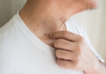 Samobadanie skóry - jak wykonać?