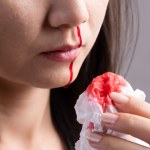 Samoistna plamica małopłytkowa. Krwawienia zagrażające życiu