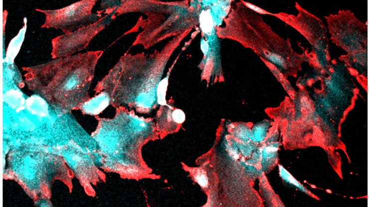 SARS-CoV-2 wychwytywany przez podocyty z nerek - na czerwono zaznaczono komórki zarażone koronawirusem /materiały prasowe