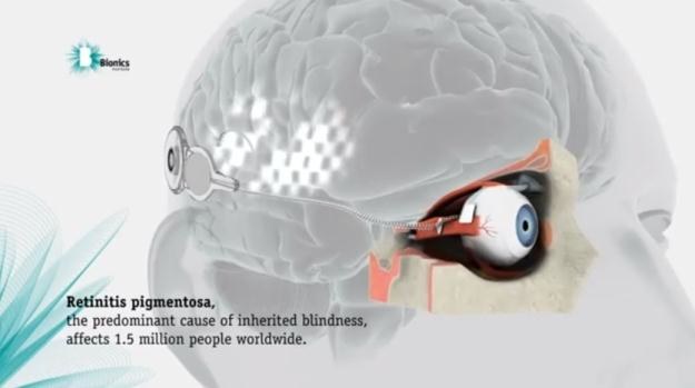 Schemat działania bionicznego oka /materiały prasowe