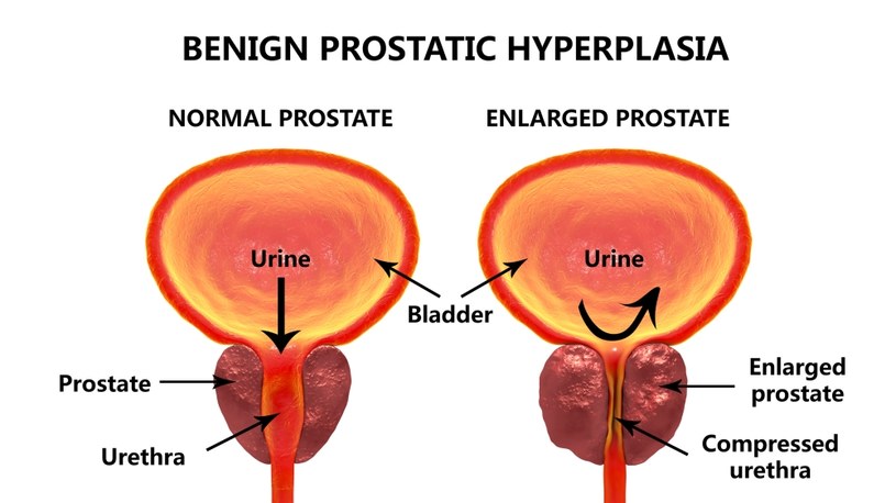 Przerost Prostaty Przyczyny Objawy Leczenie Porady W Interiapl 4170