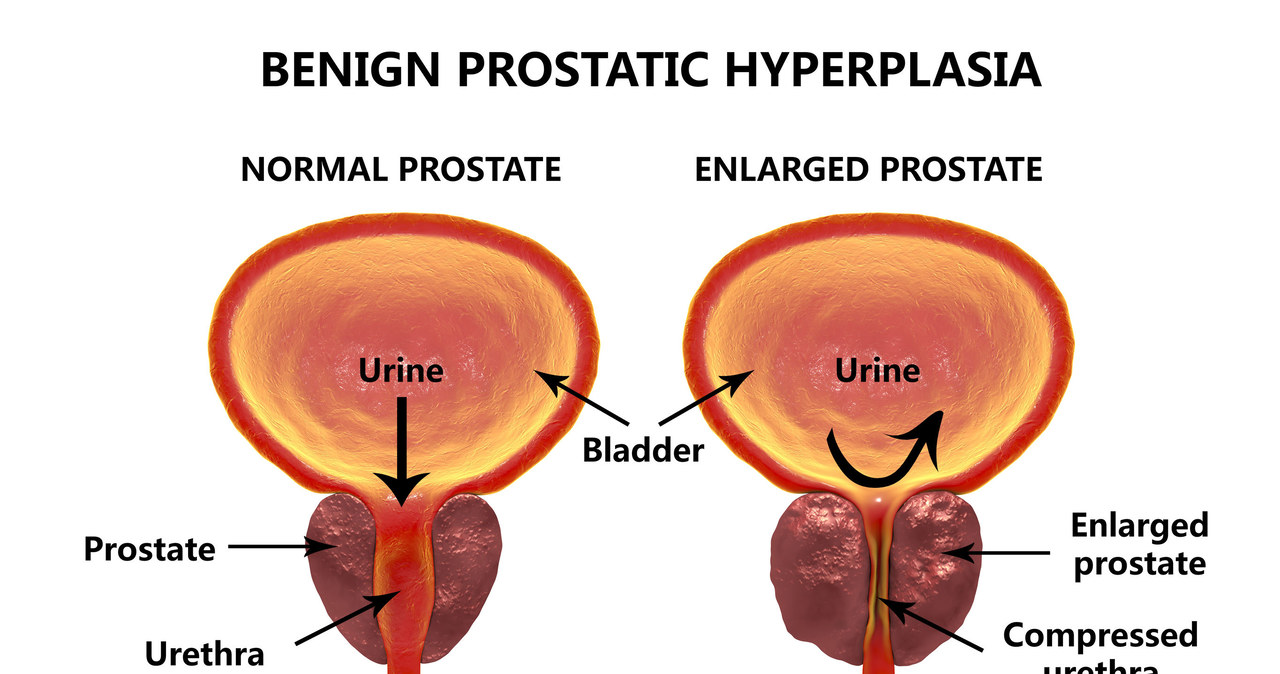 Schemat przerostu prostaty /123RF/PICSEL
