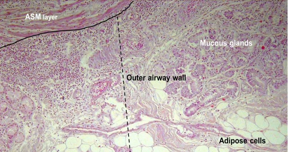 Ściana zewnętrznych dróg oddechowych wypełniona adipocytami (komórkami tłuszczowymi) /materiały prasowe