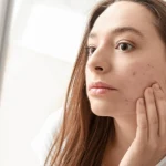 Sekrety trądzikowej mapy twarzy. O czym świadczą pryszcze w różnych strefach?