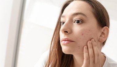 Sekrety trądzikowej mapy twarzy. O czym świadczą pryszcze w różnych strefach?
