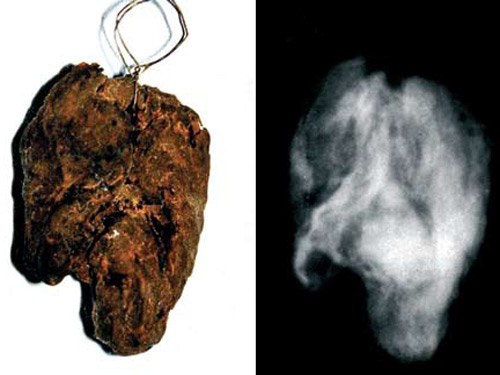Serce świętej Róży i jego obraz radiologiczny &nbsp; /Fot. Ruggero D'Anastasio/Gabriele d'Annunzio University/Lancet